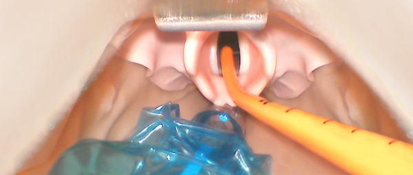 Anwendung Intubationshilfe I-Bougie